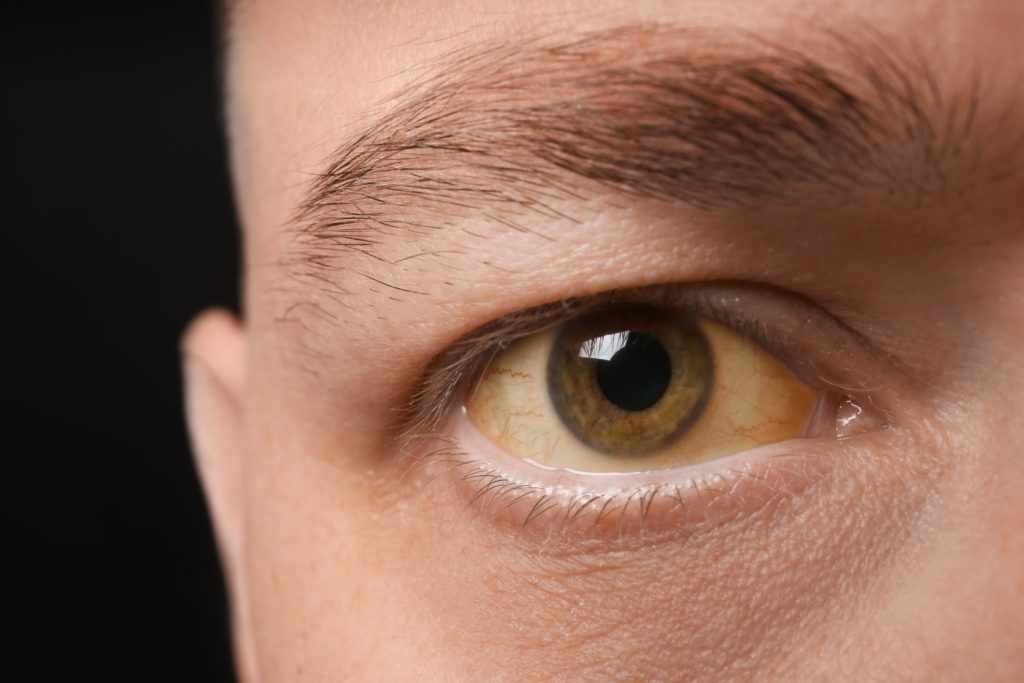 https://www.phoenixrisingrecovery.com/wp-content/uploads/2022/11/Are-yellow-eyes-from-drinking-excess-amounts-of-alcohol-1024x683.jpeg